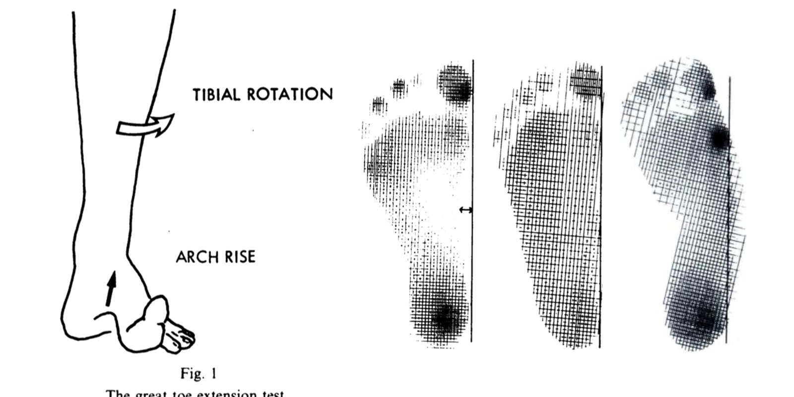 The diagnosis of flat foot in children