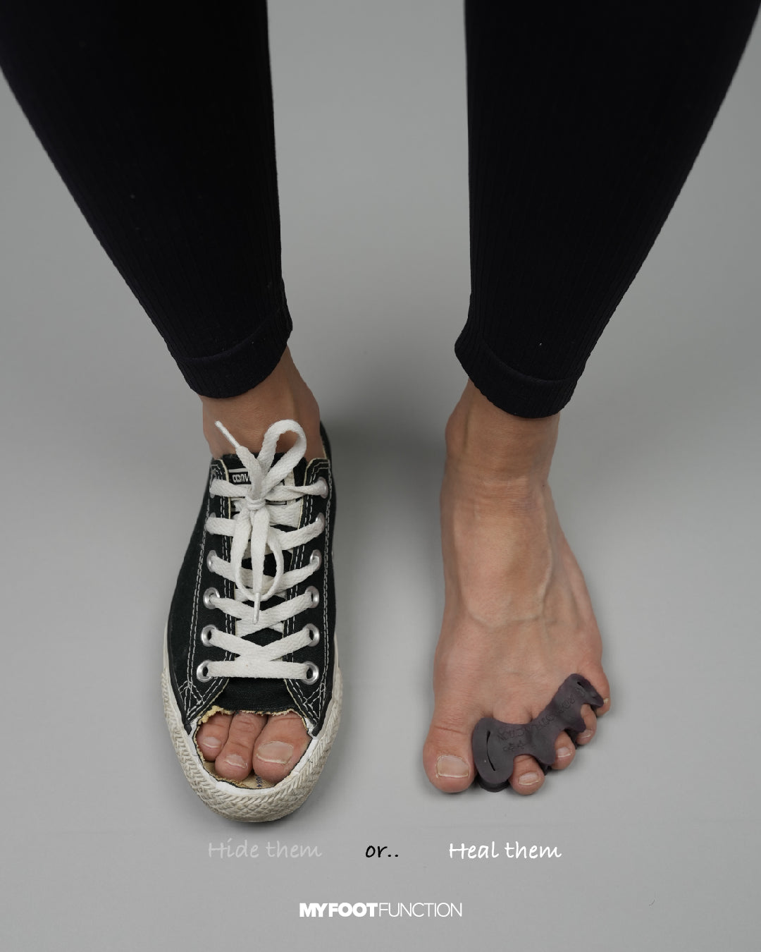 The Truth About Bunion Surgery: 64% Recurrence