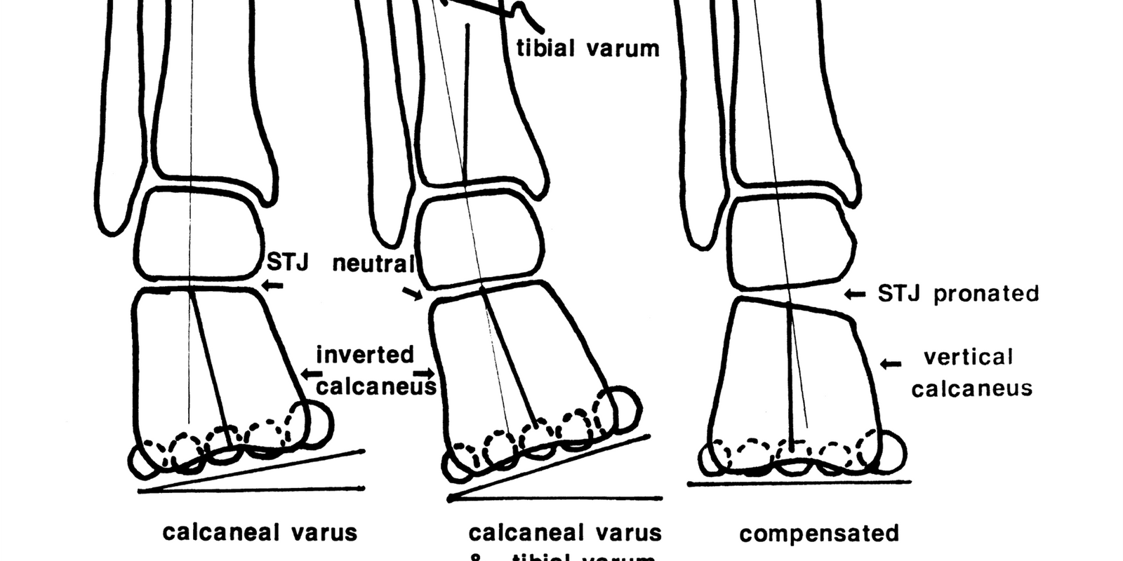Pathomechanics of Structural Foot Deformities